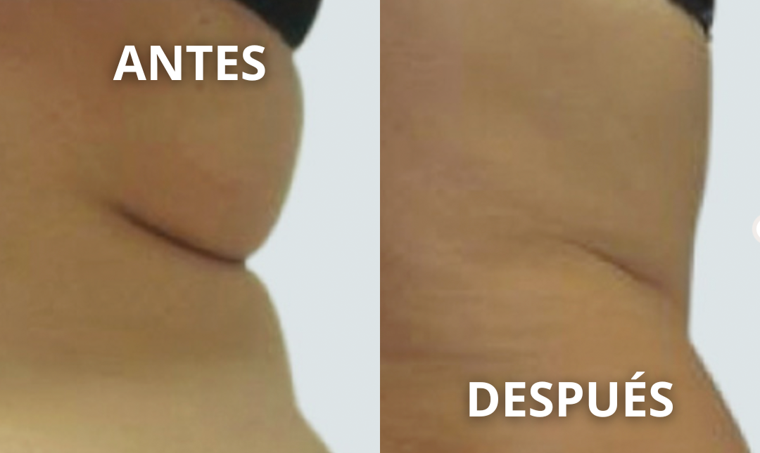 Antes y después del tratamiento Endospheres