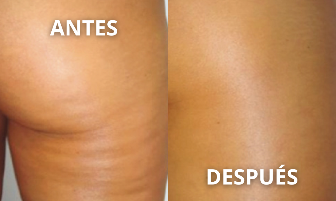 Resultado real antes y después Endospheres 1